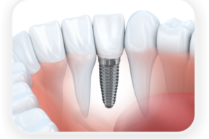 implantodontia-buriti-odontologia